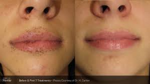 Generally, cherry angiomas don't require treatment. Skin Redness And Rosacea Treatments Lindon Ut