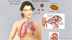 Keuchhusten Symptome Ansteckung Behandlung Netdoktor