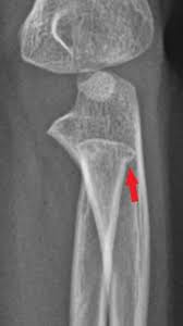 Image result for Fractures in Children