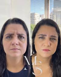 Resultado toxina botulínica. Agende agora! Divulgação autorizada pelo  usuário. Cada ser humano tem características anatômicas e fisiológicas  únicas. Procedimento realizado pelo profissional Dr. Max Sousa CRBM 23965.  #botox #harmonizacaofacial ...