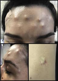 The disease begins with weakness, blurred vision, feeling tired, and trouble speaking. Granulomas Induced By Botulinum Toxin The Journal Of Allergy And Clinical Immunology In Practice