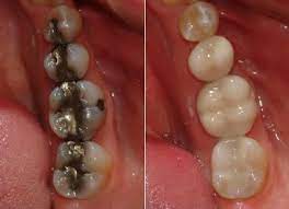 Benefits Of Tooth Colored Fillings Dentist Grand Junction Co Dental Fillings Restorative Dentistry Dental