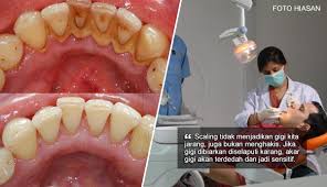 We did not find results for: Scaling Tidak Akan Menyebabkan Gigi Jarang Doktor Gigi Jelaskan Mitos Mengenai Proses Cuci Gigi Semua Semua Semuanya