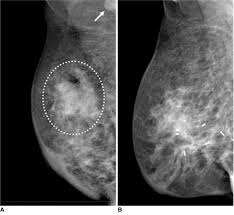 For every 100 women called back after a routine screening mammogram, about 81 do not have breast cancer. Xmlinkhub