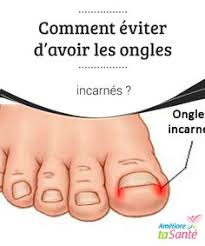 16 Idees De Ongles Incarne Ongles Incarnes Ongles Remedes Champignon Ongle Pied