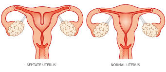 Image result for Recurrent Miscarriage