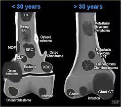 Calcifications occurring in a benign tumor or in a malignant tumor that is well differentiated may be the product of endochondral ossification. The Radiology Assistant Differential Diagnosis Of Bone Tumors