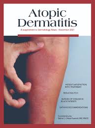 Image result for Atopic Patient