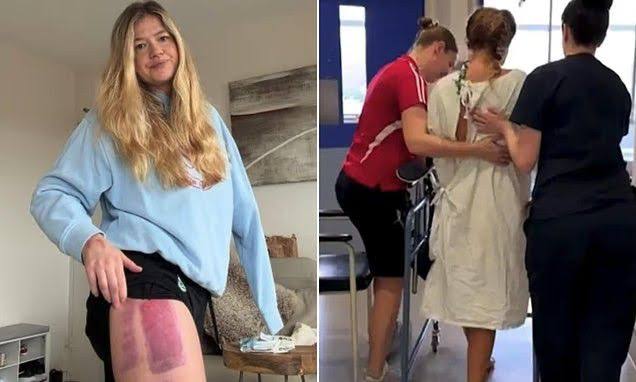 Shark Attack Survivor Leah Stewart Shares Devastating Medical Setback Three  Months After Sydney Mauling Shark attack survivor Leah Stewart has revealed  a heartbreaking medical update, confirming that a skin graft on