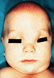 Causes Of Facial Swelling In Pediatric Patients Correlation Of Clinical And Radiologic Findings Radiographics