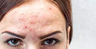 Fungal acne merupakan sebutan untuk kondisi kulit yang tampak menyerupai jerawat. Fungal Acne Beda Dari Beruntusan Ini Cara Menghilangkannya