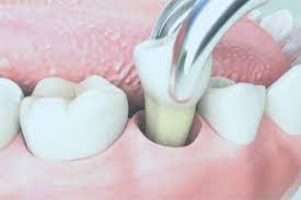 If you're still in two minds about free tooth extraction and are thinking about choosing a similar product, aliexpress is a great place to compare prices and sellers. Tooth Extraction Otahuhu Dental Care