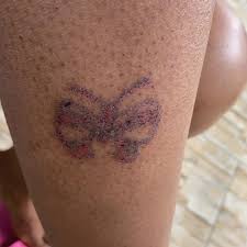 Cryotherapy can also be used in combination with steroid injections. Minor Surgical Procedures Skin Envy Dermatology