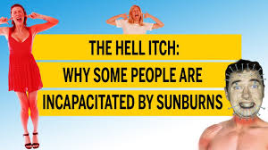 Sunburn will dry out your skin and dry skin will not only be itchy but will start to peel as well. The Hell Itch Is Real And It S The Worst Kind Of Sunburn National Post