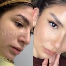 An eyebrow lift, also known as a forehead lift or forehead rejuvenation, is a kind of cosmetic procedure that enhances the appearance of the brow, forehead, and temporal or limited incision brow lift. Thread Lifts Skinatomy Laser Clinic