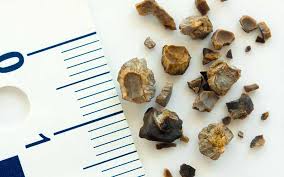 Kidney Stones Risk Factors Symptoms And Treatment
