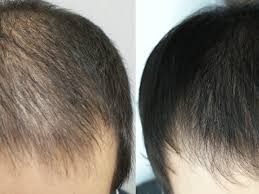 La calvitie homme ou alopécie androgénétique, touche 70% des hommes entre 30 et 40 ans, dont certains dès l'âge de 16 ans. Que Faire Contre La Calvitie Precoce The Clinic