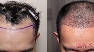 However, one of the names that stand out is dr. Fue Hair Transplant Hair Transplant Laser Skin Treatment Skin Clinic