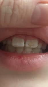Is This Enamel Hypoplasia Mumsnet