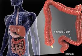 A palpable lump in the lower abdomen. Colon Cancer Symptoms Signs Screening Stages