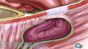 An Inguinal Hernia Is A Tough Concept To Teach To Students Hopefully This Video Can Help Me Explain It Better Hernia Repair Diverticulitis Patient Education