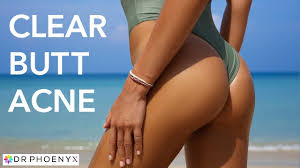 Sehen sie sich die adults acne treatment auf gigagünstig an! How To Get Rid Of Butt Acne Butt Pimples Butt Acne Scars Youtube