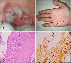 Consult a doctor for medical advice. Mucocutaneous Secondary Syphilis The Great Imitator The American Journal Of Medicine