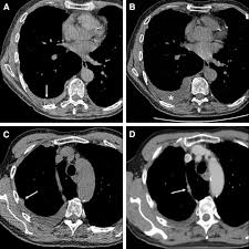 Brachytherapy for mesothelioma & other lung cancers is radiation therapy that minimizes damage to healthy tissue. Screening For Malignant Pleural Mesothelioma And Lung Cancer In Individuals With A History Of Asbestos Exposure Sciencedirect