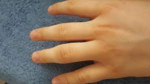 Jedes gelenk ist von einer kapsel umhüllt. Sieht Das Nach Einem Kapselriss Aus Finger Kapselriss