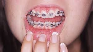 However, poor oral hygiene habits may lead to gum disease,. Adult Braces Why Are More Grown Ups Getting Their Teeth Straightened Bbc News
