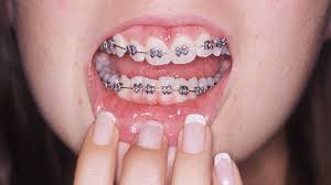 Is there a perfect age to get braces? Adult Braces Why Are More Grown Ups Getting Their Teeth Straightened Bbc News