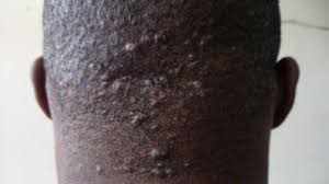 Image result for sores on the head in children