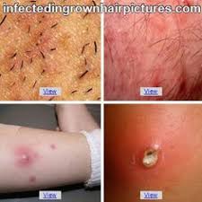 Ingrown pubic hairs are usually single bumps, while genital herpes is typically a cluster of sores or lesions. Shawn Liddle Shawnliddle Profile Pinterest