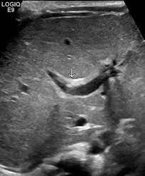 Triangular Cord Sign Radiology Reference Article Radiopaedia Org Diagnostic Medical Sonography Radiology Medical Ultrasound