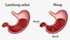 Nyeri ulut hati, mual, begah. Klinik Jn Beauty House Mengenal Gangguan Gastritis Magh