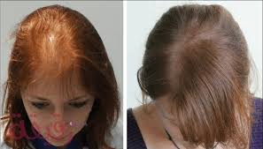 زراعة الشعر للنساء بالصور والتكلفة وتفاصيل العملية الكاملة Hair Transplant Beauty Hacks Beauty