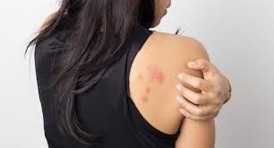 Hay diferentes tipos de dermatitis y cada uno tiene un tratamiento distinto. Covid 19 Y Las Lesiones En La Piel Que Puede Producir