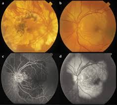 Associated cerebral vasculitis is relatively common and can cause stroke. Multimodal Imaging Of Apmppe Related Disorders