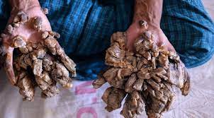 Signs and symptoms the history warts/tumors skin. Why Bangladesh S Tree Man Would Rather Get His Hands Cut Off Than Live In Pain