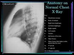 The trachea passes to the right of the aorta and so may be slightly off midline to the right. Lateral Chest X Ray Anatomy Anatomy Drawing Diagram