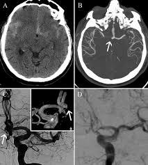 Brain aneurysms are dangerous because they can burst, causing bleeding within or on the outer. Comprehensive Review Of Imaging Of Intracranial Aneurysms And Angiographically Negative Subarachnoid Hemorrhage In Neurosurgical Focus Volume 47 Issue 6 2019