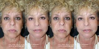 John G. Westine, MD, Board Certified Facial Plastic Surgeon