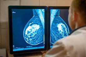 Image result for Breast Cancer Staging