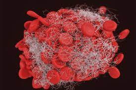Blood Clots What You Should Know Upmc Healthbeat