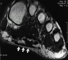 The muscles acting on the foot span from above the knee to various points on the foot skeleton. Plantar Fasciitis And Fascial Rupture Mr Imaging Findings In 26 Patients Supplemented With Anatomic Data In Cadavers Radiographics