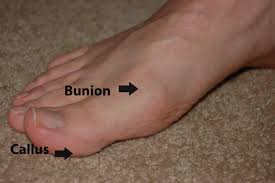 It is understandable to want to seek care this other cause of a lump on side of foot is also known as a bunionette. Common Toe Problems That Can Make Feet Look Abnormal