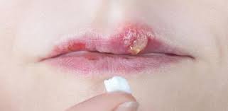 Herpes Labial Que Es Duracion Y Como Tratarlo