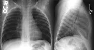 Image result for Chest XRay Interpretation