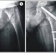 Proximal screws placement in intertrochanteric fractures ...
