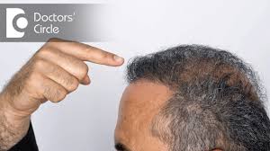 Beard hair transplant to head. What Is Body To Head Hair Transplantation Who Are The Ideal Candidatesfor It Dr K Prapanna Arya Youtube